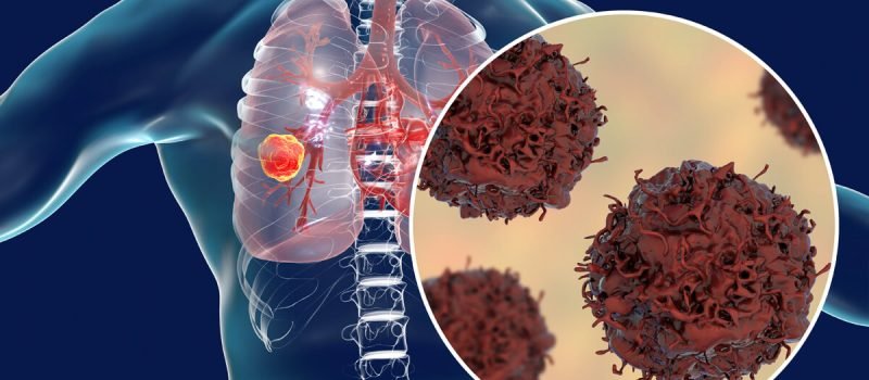Best Cancer Doctor In Indore