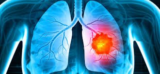 Best Cancer Doctor In Katni