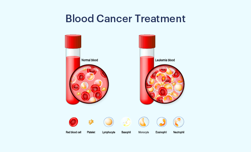 Blood Cancer treatment In Hoshangabad